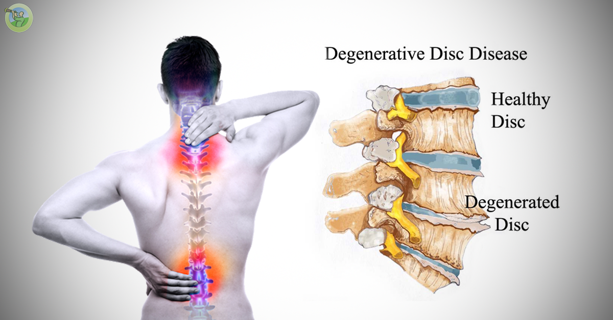 Degenerative-Disk-Disease