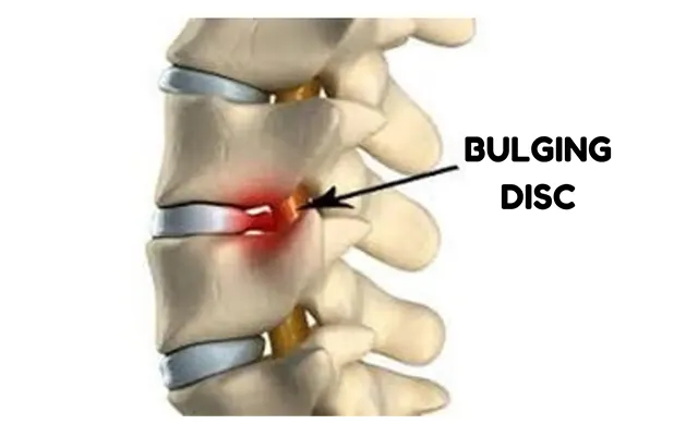 bulging-disc
