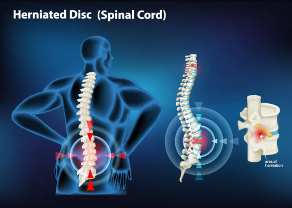 Herniated-Disc-Spinal-Cord